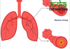 Understanding Asthma