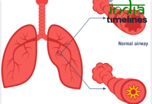 Understanding Asthma