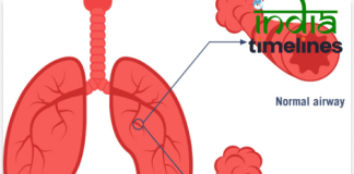 Understanding Asthma