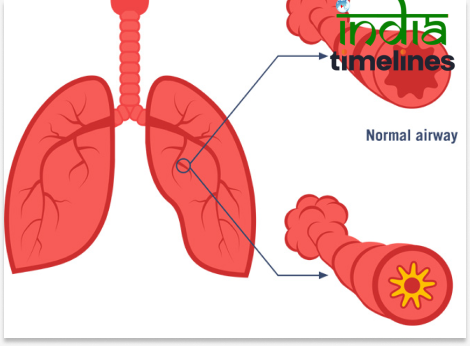 Understanding Asthma