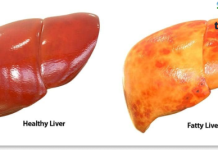 Fatty Liver Disease