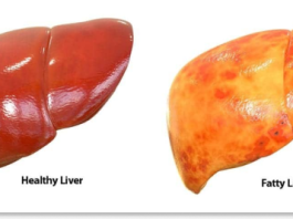 Fatty Liver Disease