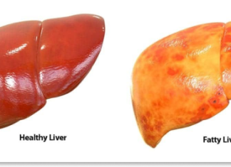 Fatty Liver Disease