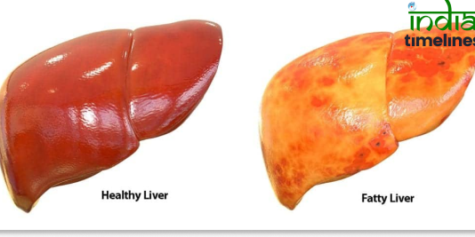 Fatty Liver Disease