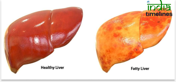 Fatty Liver Disease