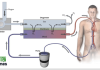 Understanding Extracorporeal Membrane Oxygenation (ECMO) Program Banner