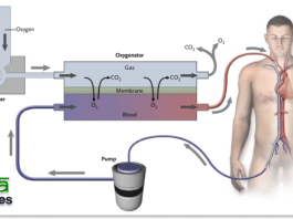 Understanding Extracorporeal Membrane Oxygenation (ECMO) Program Banner