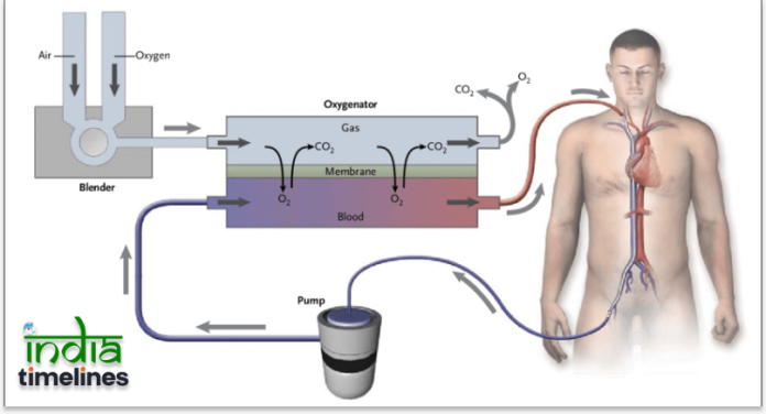 Understanding Extracorporeal Membrane Oxygenation (ECMO) Program Banner