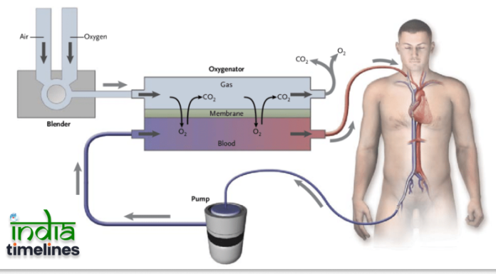 Understanding Extracorporeal Membrane Oxygenation (ECMO) Program Banner